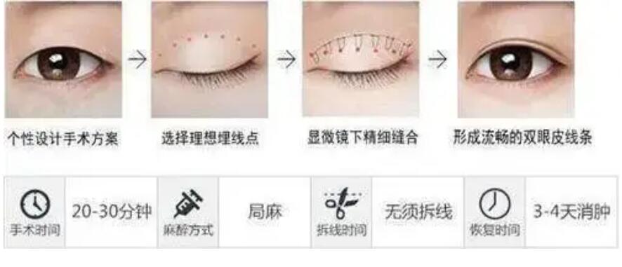 北京美憬医疗眼修复专家陈丽：为什么有的人不能做埋线双眼皮？
