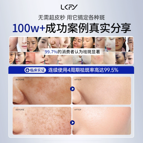 露卡菲娅祛斑套装权威认证,高效淡斑美白,铸就安全祛斑典范